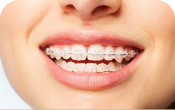 マルチブラケット矯正